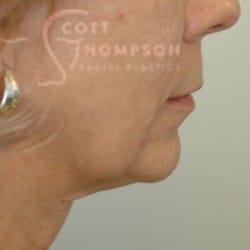 Before Image: Facelift and Chin Implant by Dr. Thompson