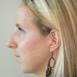 Rhinoplasty Utah Patient 331