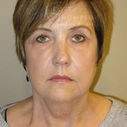 Before Image: Facelift and Chin Implant by Dr. Thompson