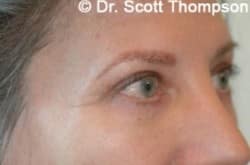 After Image: Forehead Lift, Upper and Lower Blepharoplasty by Dr. Thompson - right-front-oblique