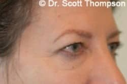 Before Image: Forehead Lift, Upper and Lower Blepharoplasty by Dr. Thompson - right-front-oblique