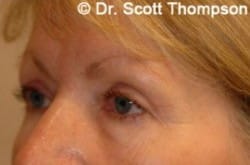 After Image: Forehead Lift Before & After Photos 223 - left-front-oblique