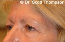 Before Image: Forehead Lift Before & After Photos 223 - left-front-oblique