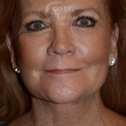 After Image: Facelift | Fat Injections | Browlift – 767 - front
