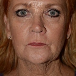 Before Image: Facelift | Fat Injections | Browlift – 767 - front