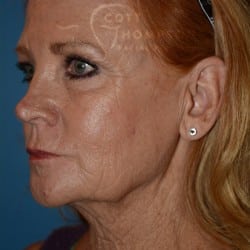 Before Image: Facelift | Fat Injections | Browlift – 767 - left-front-oblique