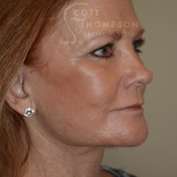 After Image: Facelift | Fat Injections | Browlift – 767 - right-front-oblique