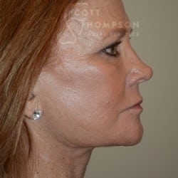 After Image: Facelift | Fat Injections | Browlift – 767 - right-front-oblique