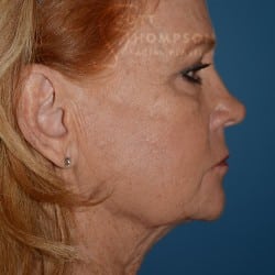 Before Image: Facelift | Fat Injections | Browlift – 767 - right-front-oblique