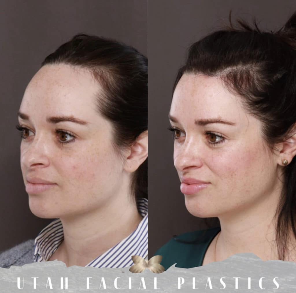 Forehead Reduction Before and After