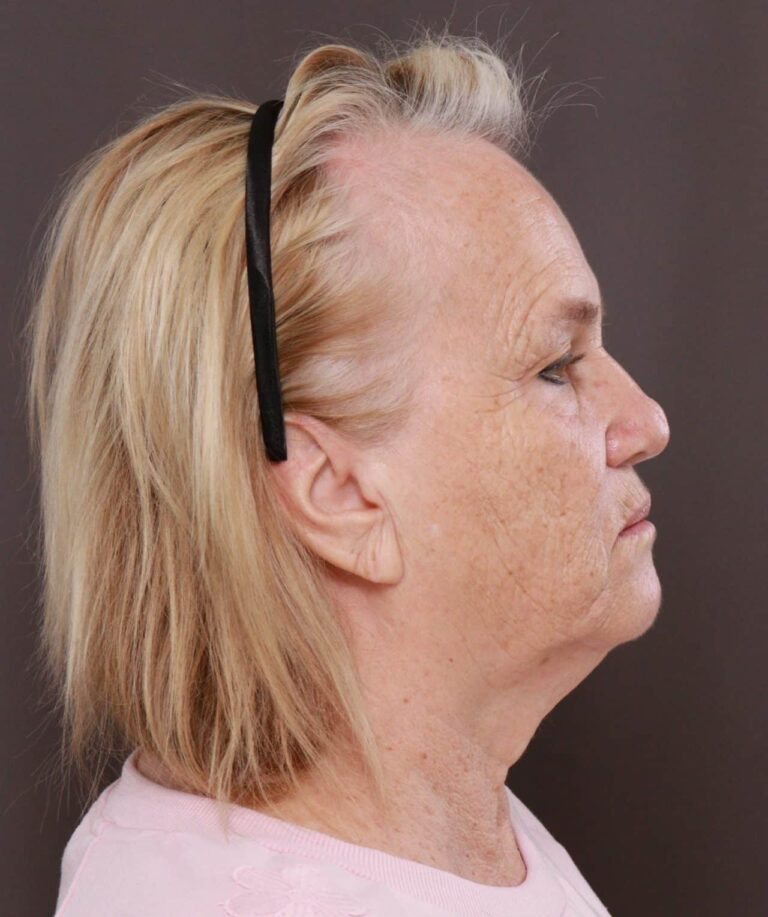 Before Image: Contour TRL & BBL by Katy Larson - right-side