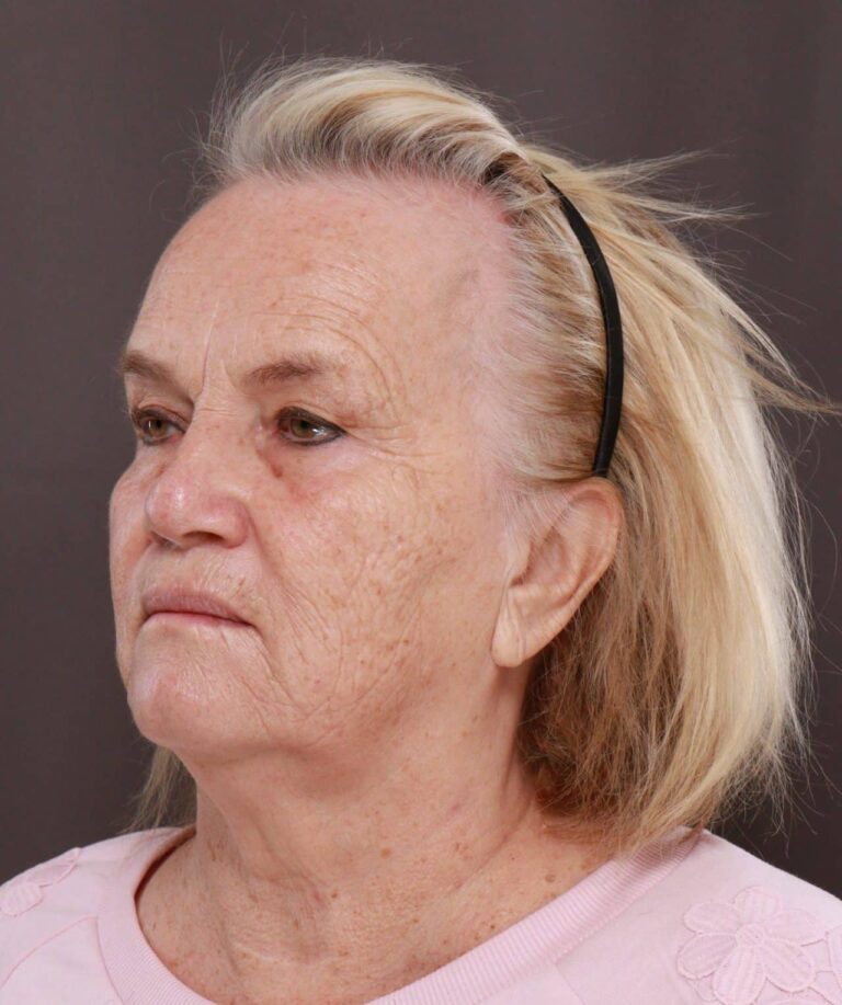 Before Image: Contour TRL & BBL by Katy Larson - left-front-oblique