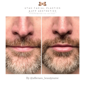 Mens lip filler
