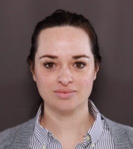 Before Image: Forehead Reduction by Dr. Thompson