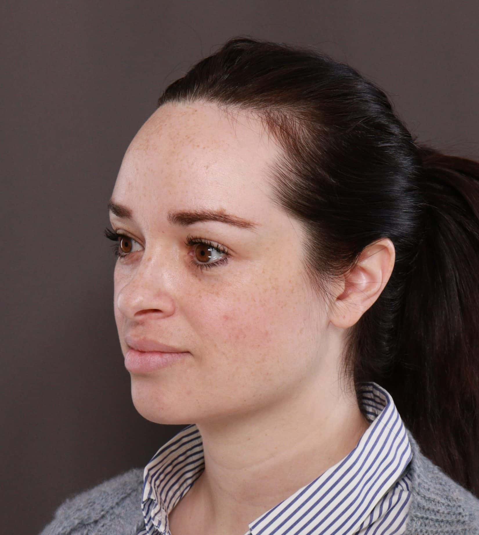 Forehead Reduction by Dr. Thompson Utah Facial Plastics