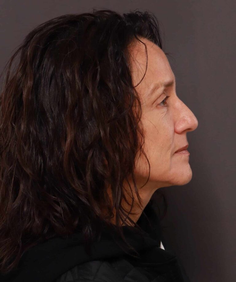 After Image: Lower Blepharoplasty with Periorbital Fat Transfer by Dr. Henstrom - right-side