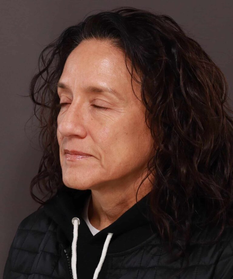 After Image: Lower Blepharoplasty with Periorbital Fat Transfer by Dr. Henstrom - left-front-oblique