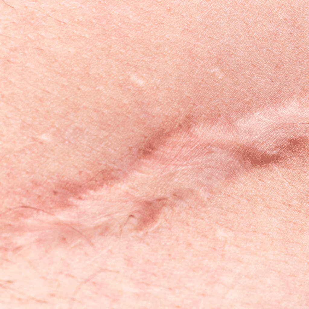 scar scar