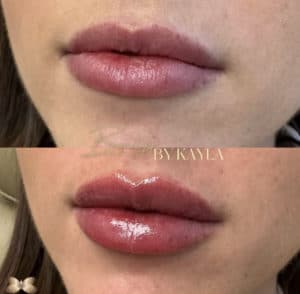 womens lip filler