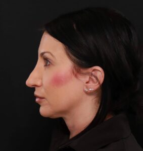 Rhinoplasty Revision by Dr. Henstrom