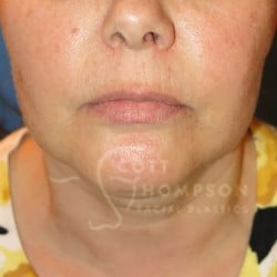 Before Image: Submental Liposuction by Dr. Thompson - front