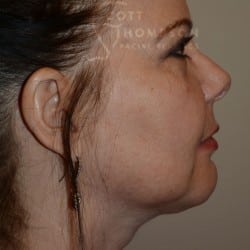 After Image: Submental Liposuction by Dr. Thompson - right-side