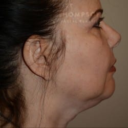 Before Image: Submental Liposuction by Dr. Thompson - right-side
