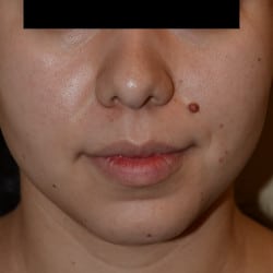 After Image: Submental Liposuction by Dr. Thompson - front