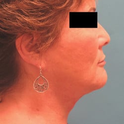 After Image: Direct Necklift by Dr. Henstrom