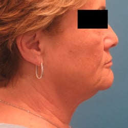 Before Image: Direct Necklift by Dr. Henstrom