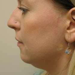 Before Image: Rhinoplasty and Submental Lipo by Dr. Thompson - left-side