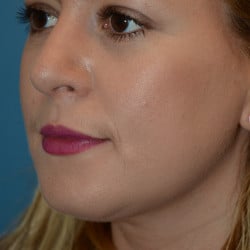 After Image: Rhinoplasty and Submental Lipo by Dr. Thompson - left-front-oblique