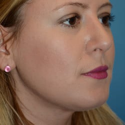 After Image: Rhinoplasty and Submental Lipo by Dr. Thompson - right-front-oblique