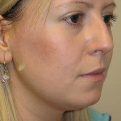 Before Image: Rhinoplasty and Submental Lipo by Dr. Thompson - right-front-oblique