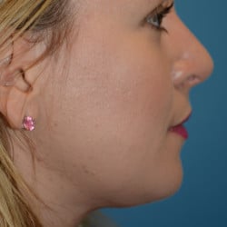 After Image: Rhinoplasty and Submental Lipo by Dr. Thompson - right-side