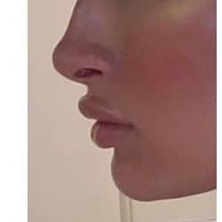 After Image: Kybella - left-side