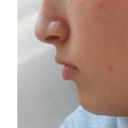 Before Image: Kybella - left-side