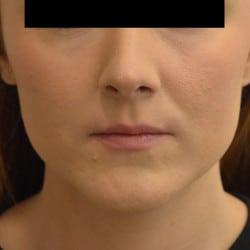 After Image: Septorhinoplasty by Dr. Thompson - front