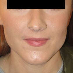Before Image: Septorhinoplasty by Dr. Thompson - front