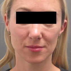 After Image: Rhinoplasty by Dr. Henstrom - front
