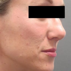 After Image: Rhinoplasty by Dr. Henstrom - right-front-oblique