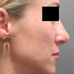 After Image: Rhinoplasty by Dr. Henstrom - right-side