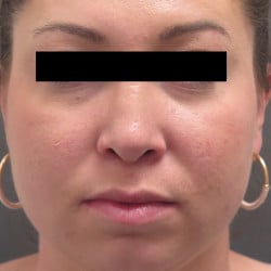 After Image: Rhinoplasty by Dr. Henstrom - front