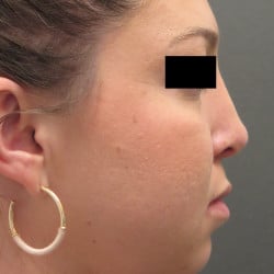 After Image: Rhinoplasty by Dr. Henstrom - right-side