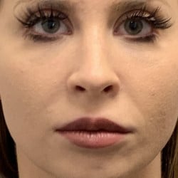 After Image: SeptoRhinoplasty by Dr. Thompson - front