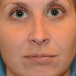 Before Image: SeptoRhinoplasty by Dr. Thompson - front