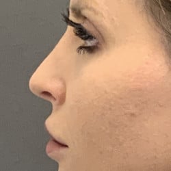 After Image: SeptoRhinoplasty by Dr. Thompson - left-side