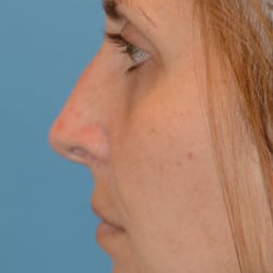Before Image: SeptoRhinoplasty by Dr. Thompson - left-side