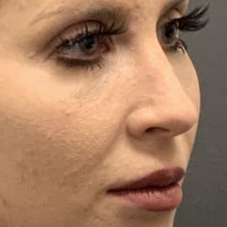 After Image: SeptoRhinoplasty by Dr. Thompson - right-front-oblique