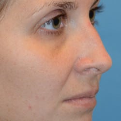 Before Image: SeptoRhinoplasty by Dr. Thompson - right-front-oblique